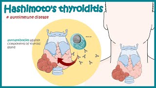 Hashimotos thyroiditis  Autoimmune diseases [upl. by Chappell]