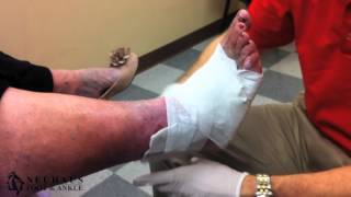 Treatment of an Ulcer with an Unna Boot [upl. by Ruffo53]