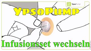 YpsoPump Patrone wechseln Insulinpumpe mylife Diabetescare 08 [upl. by Rellek]