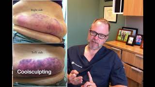 Sculpsure vs Coolsculpting  Which One is Better [upl. by Ajaj]