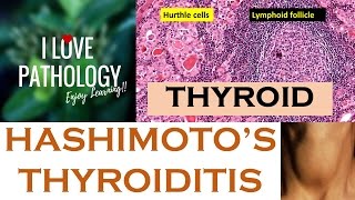 HASHIMOTOS THYROIDITIS Etiopathogenesis Morphology amp Complications [upl. by Phiona909]