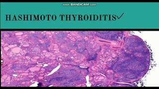 HASHIMOTOS Thyroiditis 5 Things YOU Need to Know 2024 [upl. by Olympia]