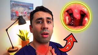 What Causes a Sore Throat HOME Remedies and Cures for Fast TREATMENT Doctor Explains [upl. by Ecinna]